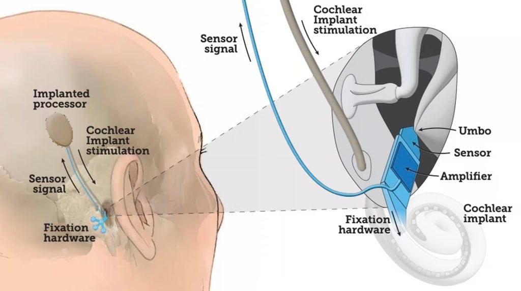 Can UmboMic Revolutionize Implantable Microphones?